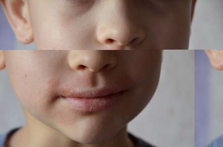 close up lips and face of a schoolboy or teenager with allergies. Lip irritation. Portrait of smiling child sneezing, scratching nose, seasonal allergy, modern illness.の写真素材