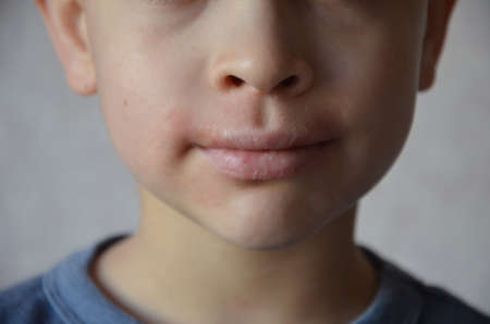close up lips and face of a schoolboy or teenager with allergies. Lip irritation. Portrait of smiling child sneezing, scratching nose, seasonal allergy, modern illness.の写真素材