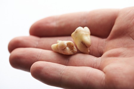 Closeup of two tooth lay on palm of hand. Macro of old teethの写真素材