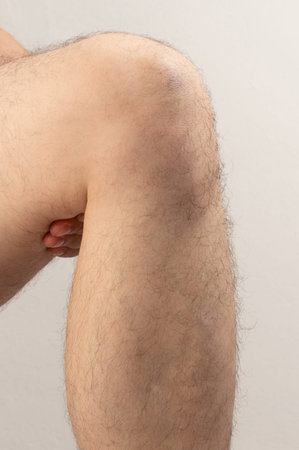 Knee with bruise isolated on white studio background close up viewの写真素材