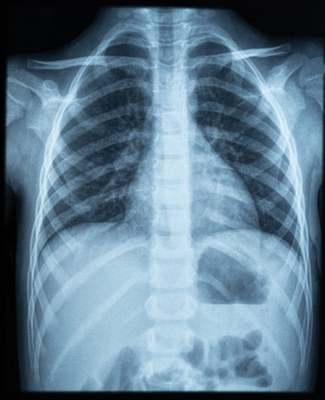 X ray photo image of chest area of young kid. X-ray lungs radiographyの写真素材