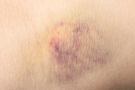 Purple bruise on human skin macro close up viewの写真素材