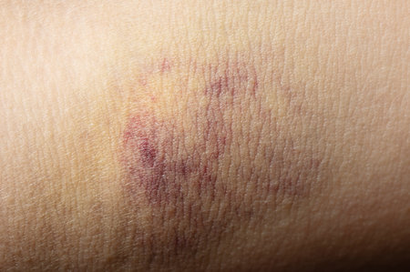 Red bruise on human skin macro close up viewの写真素材