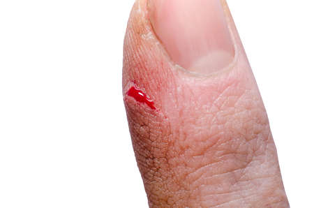 Wound on a man's finger close-upの写真素材