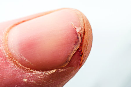 Close-up of a cut on a finger, showing a torn nail and surrounding skinの写真素材