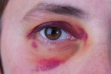 Human eye with a large purple bruiseの写真素材
