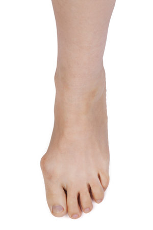 Leg with deformed joint on a white background