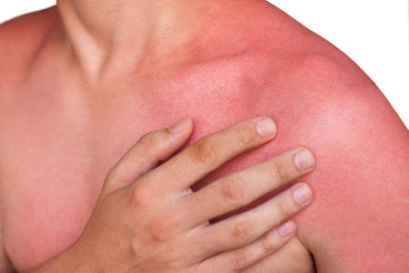 A man with reddened, itchy skin after sunburn. Skin care and protection from the sun's ultraviolet rays.の写真素材