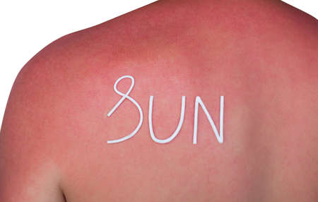 man with reddened, itchy skin after sunburn. Cream on the back. Skin care and protection from the sun's ultraviolet rays.の写真素材
