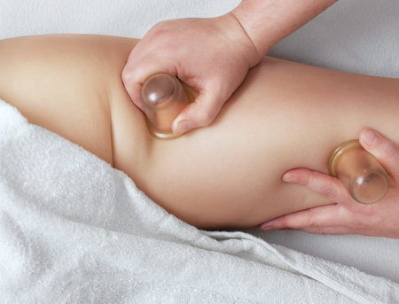 The masseur makes massage with jars of cellulite on the buttock and thighs of the patient. Treatment...