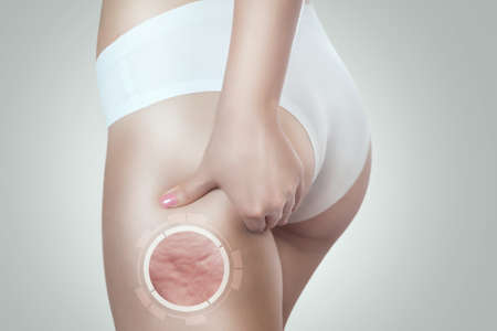 Woman shows cellulite on her thigh. Obesity treatment.の写真素材