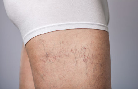 the dilation of small blood vessels of the skin on the leg. Medical inspection and treatment of...