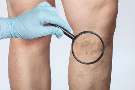 doctor shows the dilation of small blood vessels of the skin on the leg. Medical inspection and treatment of Telangiectasia, cosmetologyの素材 [FY310134343631]