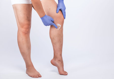 Man in blue gloves shows the dilation of small blood vessels of the skin on the leg. Medical inspection and treatment of Telangiectasia. Phlebeurysm.の写真素材