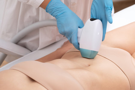Elos epilation hair removal procedure on a woman's body. Beautician doing laser rejuvenation on the...