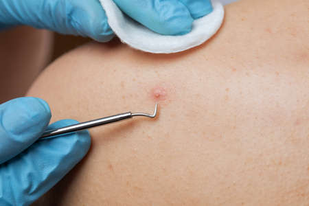 A dermatologist cleans the skin from acne on the back and shoulders of a teenager.の写真素材