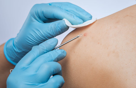 A dermatologist cleans the skin from acne on the back and shoulders of a teenager.