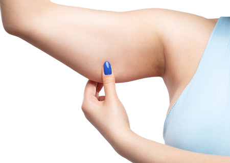 A fat woman in a blue t-shirt shows fat deposits on her arms. overweight treatment.の写真素材