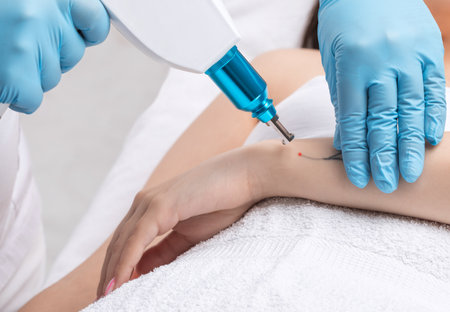 The doctor makes the procedure for laser tattoo removal on the girl's arm.の写真素材