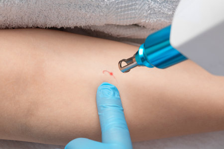 The doctor makes the procedure for laser tattoo removal on the girl's arm.の写真素材
