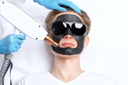 Beautician doing carbon peeling procedure to handsome guy in beauty salon. Hardware male cosmetology.の写真素材