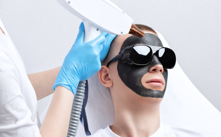 Beautician doing carbon peeling procedure to handsome guy in beauty salon. Hardware male cosmetology.の写真素材
