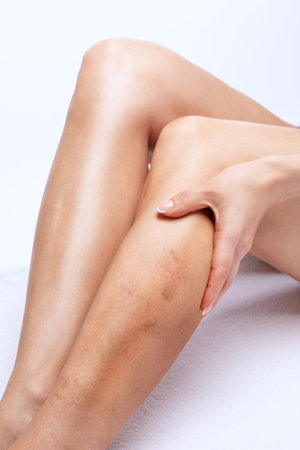 Beautiful slender woman sits on a couch in a spa salon. She shows varicose veins in the lower legs.Treatment of varicose veins and capillaries.の写真素材