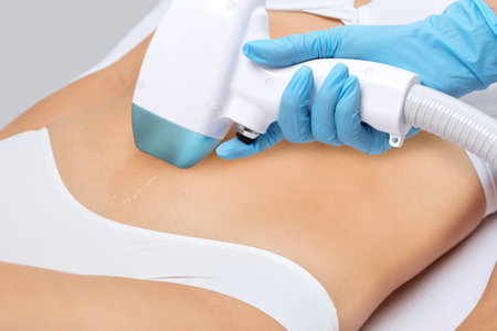 Elos epilation, hair removal procedure on a woman's body. Beautician doing laser rejuvenation in a beauty salon. Removing unwanted body hair. hardware ipl cosmetologyの写真素材