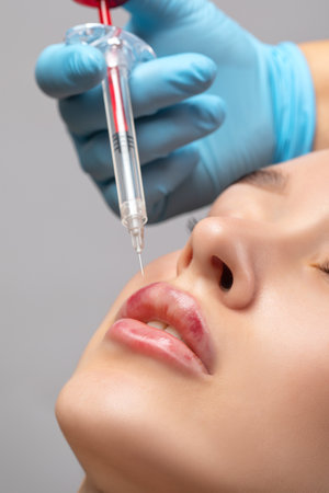 Injections for lips augmentation anti wrinkle injections on the face of a beautiful woman. Female aesthetic cosmetology in a beauty salon. Hematomas after lip contouring.の写真素材