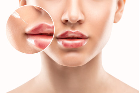 Injections for lips augmentation anti wrinkle injections on the face of a beautiful woman. Female aesthetic cosmetology in a beauty salon. Hematomas after lip contouring.の写真素材