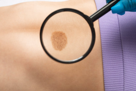 On the woman's stomach, the doctor examines the problem area of the skin with a large mole.の写真素材