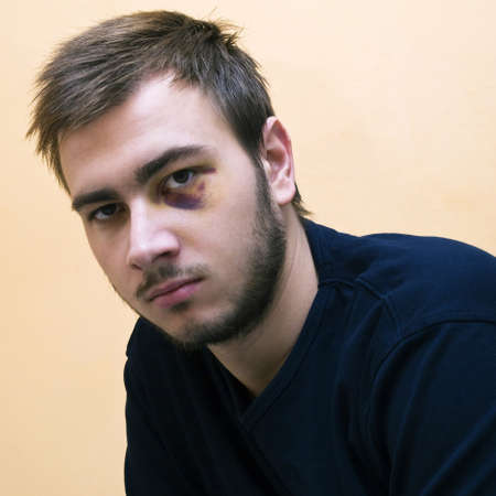 Young man with a black eyeの写真素材