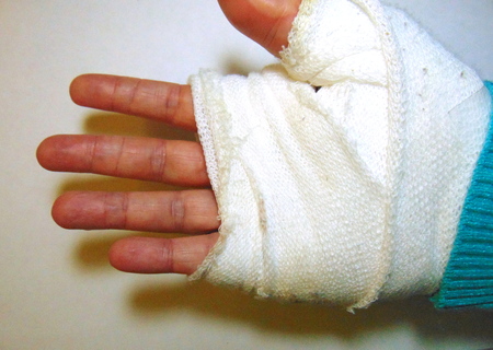 hand woundの写真素材
