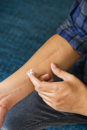 asian man applying scar removal cream to scar wound form broken hand medical surgery, skin care product, scars care healingの写真素材