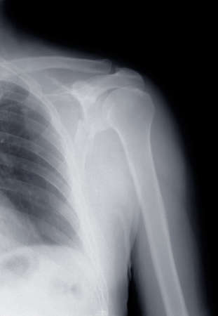 X-ray Shoulder 