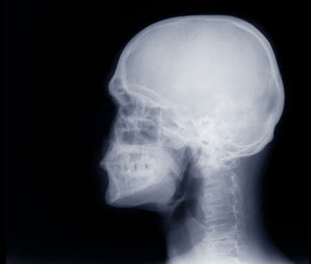 X-ray of Human Skullの写真素材