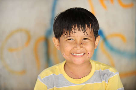 Chickenpoxの写真素材