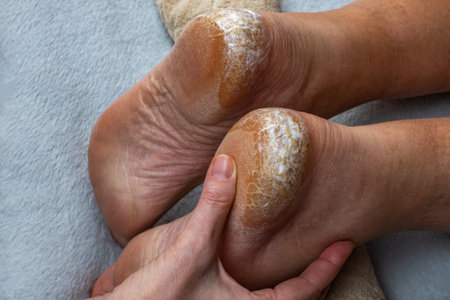 Applying cream to cracked heels. Close-up of a womans hand applying a moisturizing nourishing cream to the heels of the feet with dry cracked skin. Skin treatment conceptの写真素材