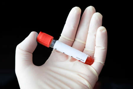 Scientist holding test tube with blood sample on black background, closeup. Virus research. empty...