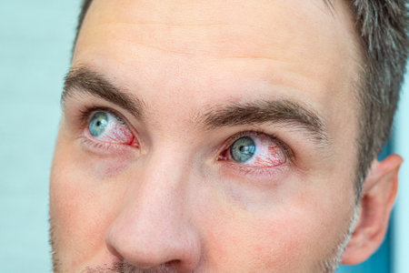 Close up of two annoyed red blood eyes of male affected by conjunctivitis or after fly, color allergy. Concept of health, disease and treatment.の写真素材