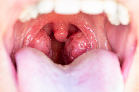 Closeup view of open mouth with tonsils. The child is a patient with large red glands. Tonsils in close-up in the mouth.の写真素材