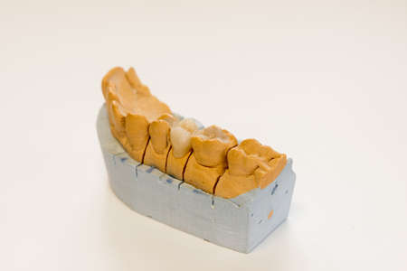 Dental gypsum model in dentist laboratory office - close-up.  Gypsum Dentures with porcelain teeth...