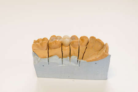 Dental gypsum model in dentist laboratory office - close-up.  Gypsum Dentures with porcelain teeth...