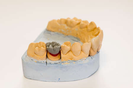 Dental gypsum model in dentist laboratory office - close-up.  Gypsum Dentures with porcelain teeth...