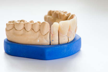 Dental gypsum model in dentist laboratory office - close-up.  Gypsum Dentures with porcelain teeth isolated on white background - copy spaceの写真素材