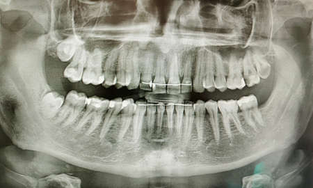 X-ray picture of the teeth of a young adult manの写真素材