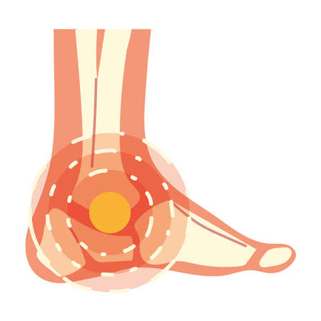 arthritis foot pain isolated styleのイラスト素材