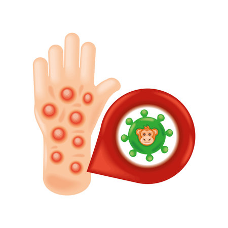human hand with monkeypox skin infectionのイラスト素材