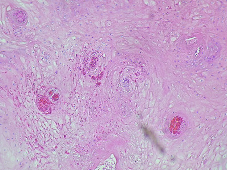 Photomicrograph of verruca vulgaris in the dextra pedis region under a microscope in the anatomical pathology laboratoryの写真素材