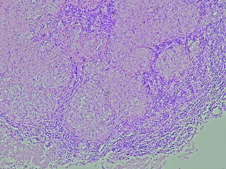Photomicrograph of soft tissue tumor of colli area with microscopic results of specific chronic...